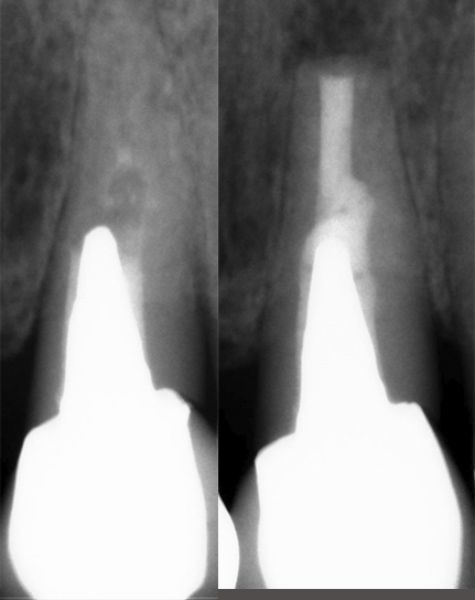 Endodontische Chirurgie